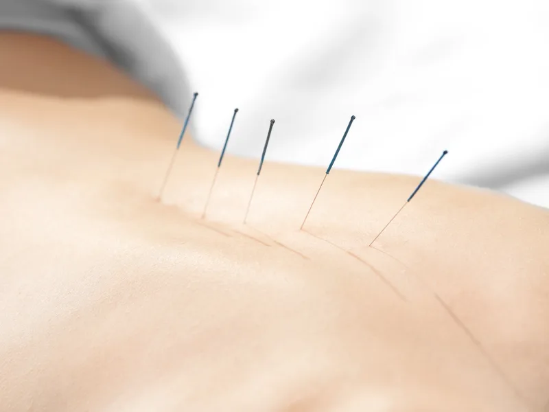 Acupuncture at Honolulu Pain Relief Center in Honolulu